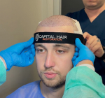 Capital Hair Restoration - Hair Transplant