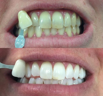 Crest tooth whitening strips: 