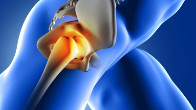 Hip Replacement Surgery In India: 