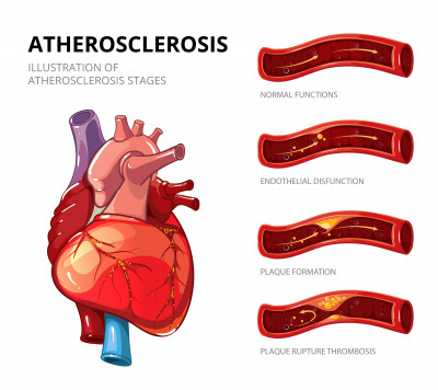 Coronary Artery Bypass Surgery Cost In India: 