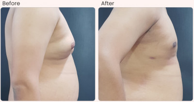 How to know if You Have Gynecomastia?: 