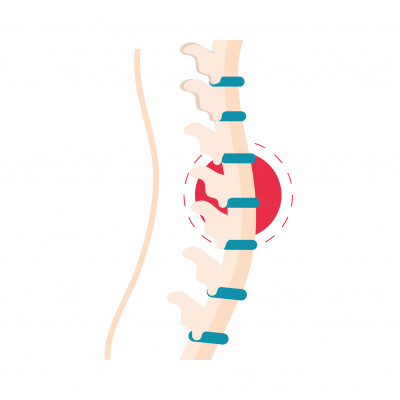 Spinal Cord Tumor Treatment In India: 