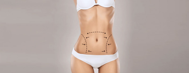 Drainless Tummy Tuck: What Is It and How Does It Compare to a Tummy Tuck with Drains - Dr. Lokesh Handa